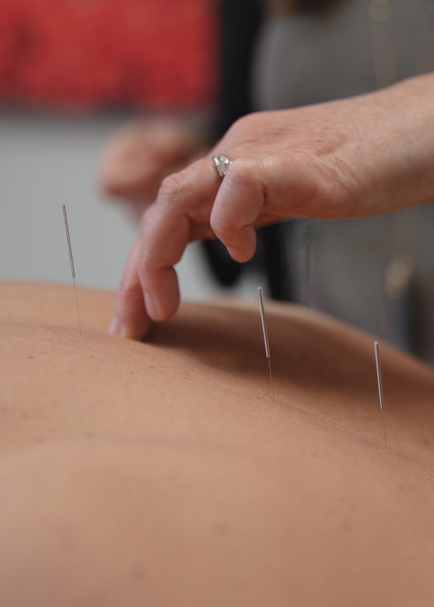 Acupuncture